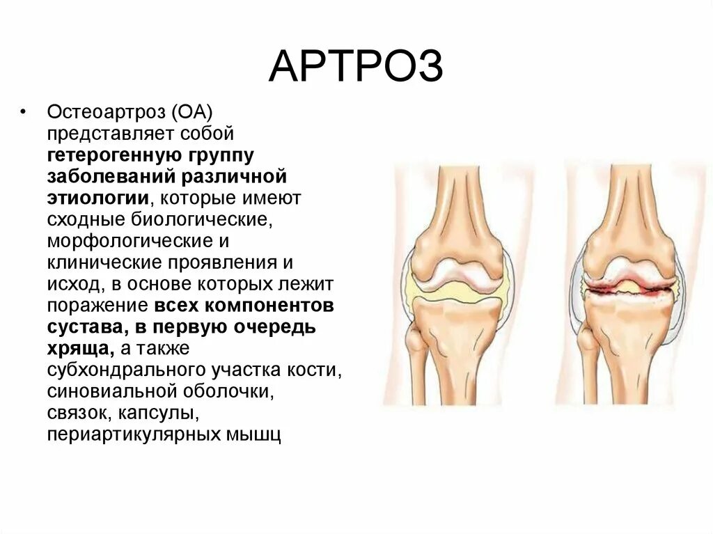 Артрит и артроз разница. Диффузный остеоартроз. Ретропателлярный остеоартроз. Деформирующий остеоартроз исход. Деформирующий остеоартроз симметричность.