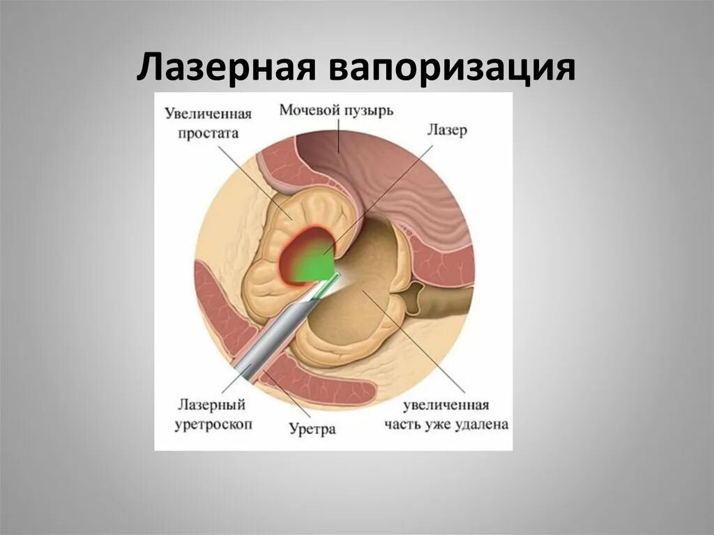 Простата лечение форум. Лазерная вапоризация предстательной железы. Лазерная абляция аденомы предстательной. Трансуретральная вапоризация простаты. Аденома простаты операция лазером.