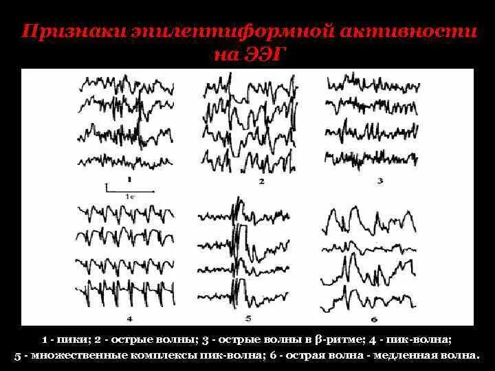 Комплексы пик волна на ЭЭГ. Эпиактивность на ЭЭГ. ЭЭГ при эпилепсии пик волна. Комплекс острая волна медленная волна на ЭЭГ. Медленные волны на ээг