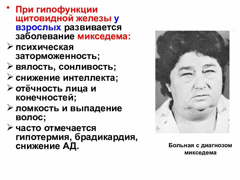 Какие гипофункции желез. При гипофункции щитовидной железы. микседема щитовидной железы.