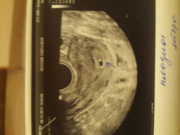 Плод 3-4 недели беременности на узи. Узи 3-4 недели беременности. Узи плодного яйца на 2-3 недели. Узи в три недели беременности от зачатия. 3 недели от зачатия узи.