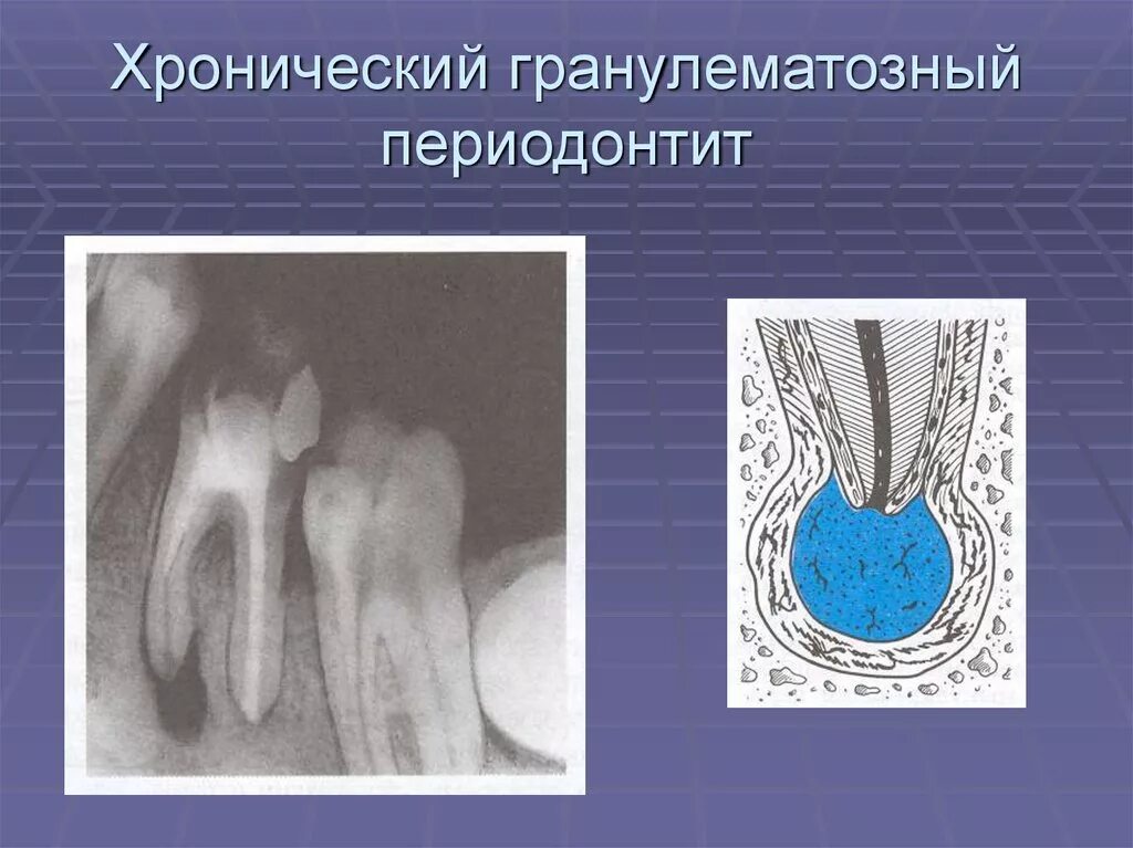 Фиброзный периодонтит. Гранулематозный апикальный периодонтит. Периодонтит фиброзный гранулематозный гранулирующий. Хронический гранулирующий периодноти. Периапикальная гранулема.