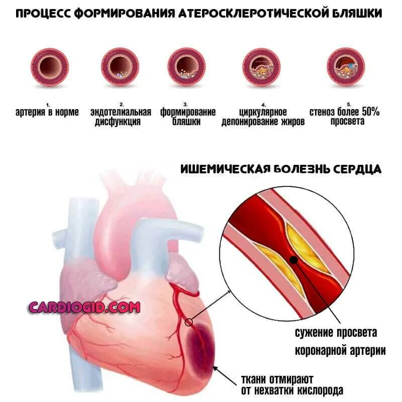 Осложнения стеноза