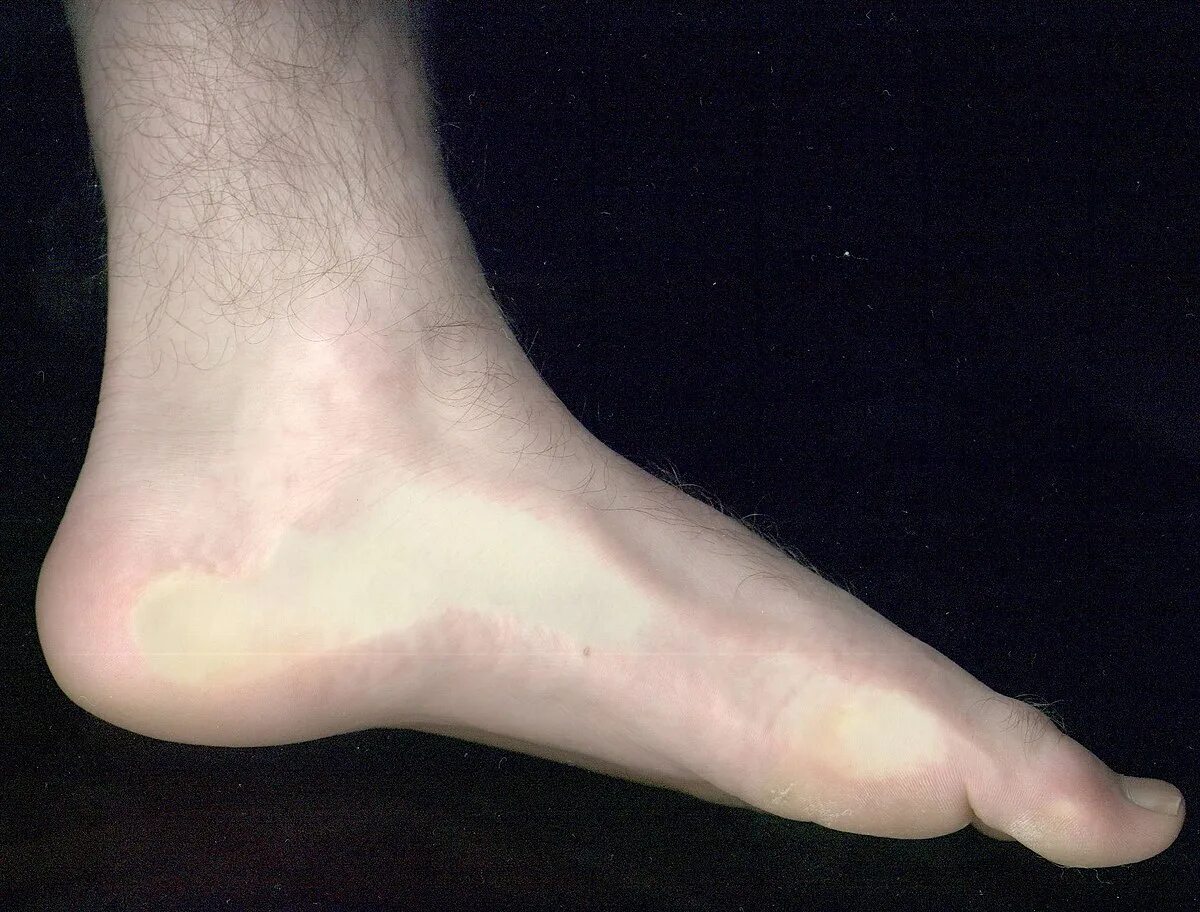 Side of foot Spleen acupoints. Foot side