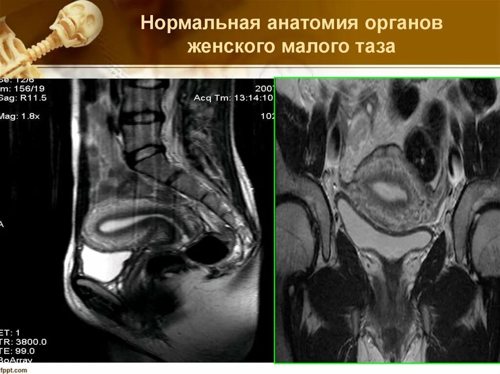 Кт органов таза у мужчин. Мрт анатомия малого таза. Мрт анатомия малого таза женщины. Кт анатомия органов малого таза. Кт анатомия малого таза у женщин.