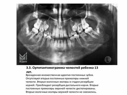 Зубы отсутствуют у