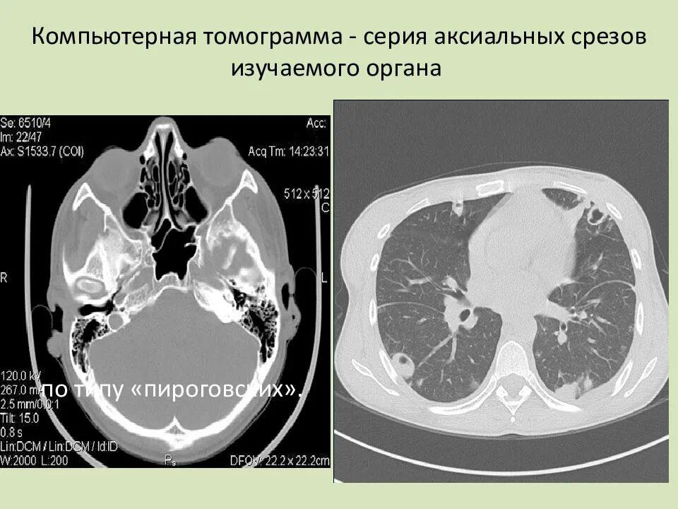 Разновидности кт. Срезы кт. Срезы кт. Кт брюшной полости аксиальный срез. Срезы кт.