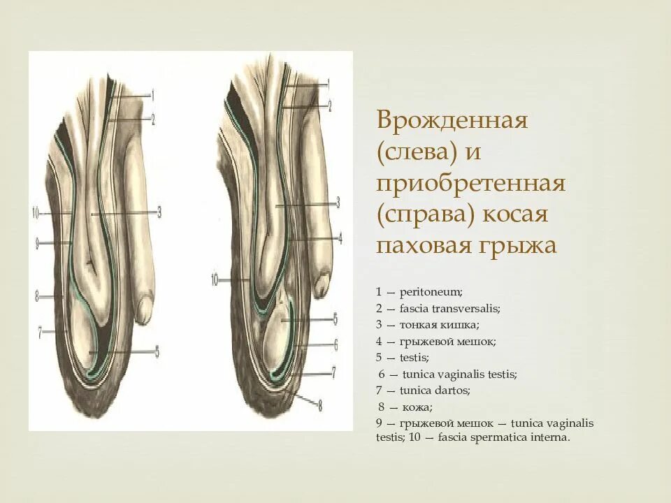 Врожденная и приобретенная паховая грыжа. Косая приобретенная паховая грыжа. Врожденная и приобретенная косая паховая грыжа. Косая паховая грыжа хирургическая анатомия. Прямая и косая паховые грыжи