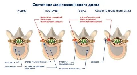 Протрузия это простыми словами