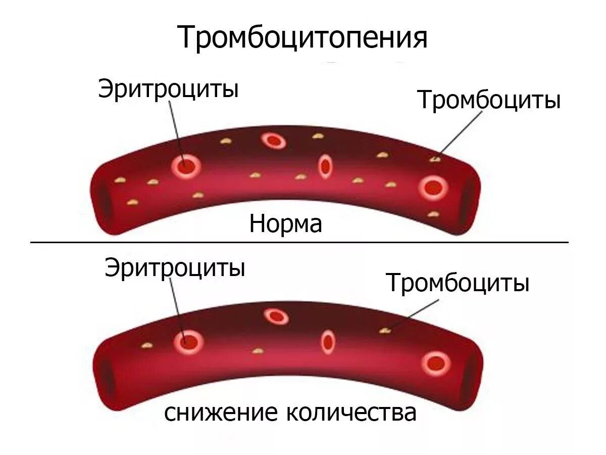 Тромбопения это. Тромбоцитопения характерна для:. Тромбоцитопения картинки.