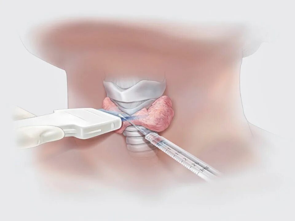 Как берут биопсию у мужчин. Пункционная биопсия щитовидной железы. Пункционно-аспирационная биопсия. УЗИ щитовидной железы с пункцией узла. Пункция узла щитовидной железы.
