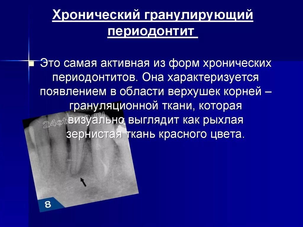 Фиброзный периодонтит. Обострение хронического периодонтита рентген. Зуб 16 хронический периодонтит. Грануляционный периодонтит. Периодонтит очаг хронической инфекции.