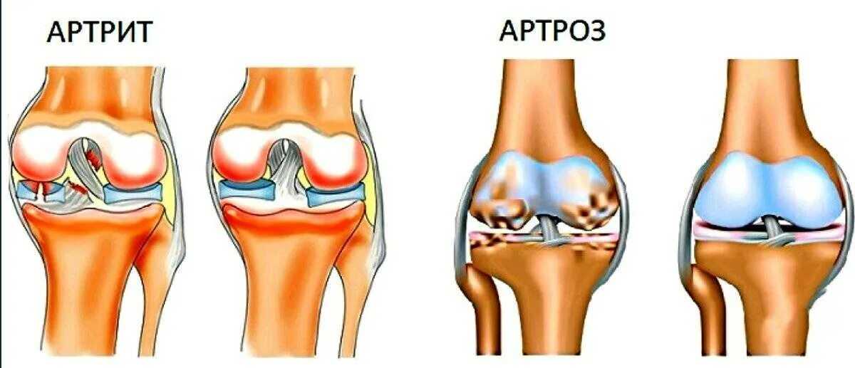 Артрит и артроз разница. Ревматоидный артрит и артроз. Остеоартрит коленного сустава. Артрит и артроз коленного сустава.