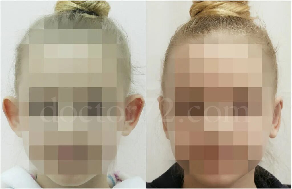 лопоухость до и после операции. пластика широкого носа. лазерная отопластика операция.