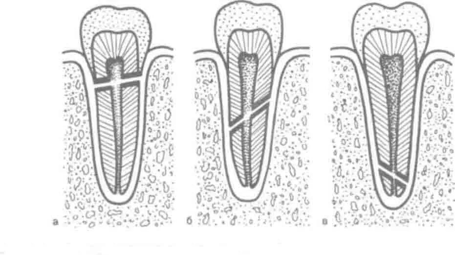 Перелом корня зуба классификация. Перелом корня депульпированного зуба. Перелом коронки зуба с повреждением пульпы. Перелом коронки зуба с обнажением пульпы.