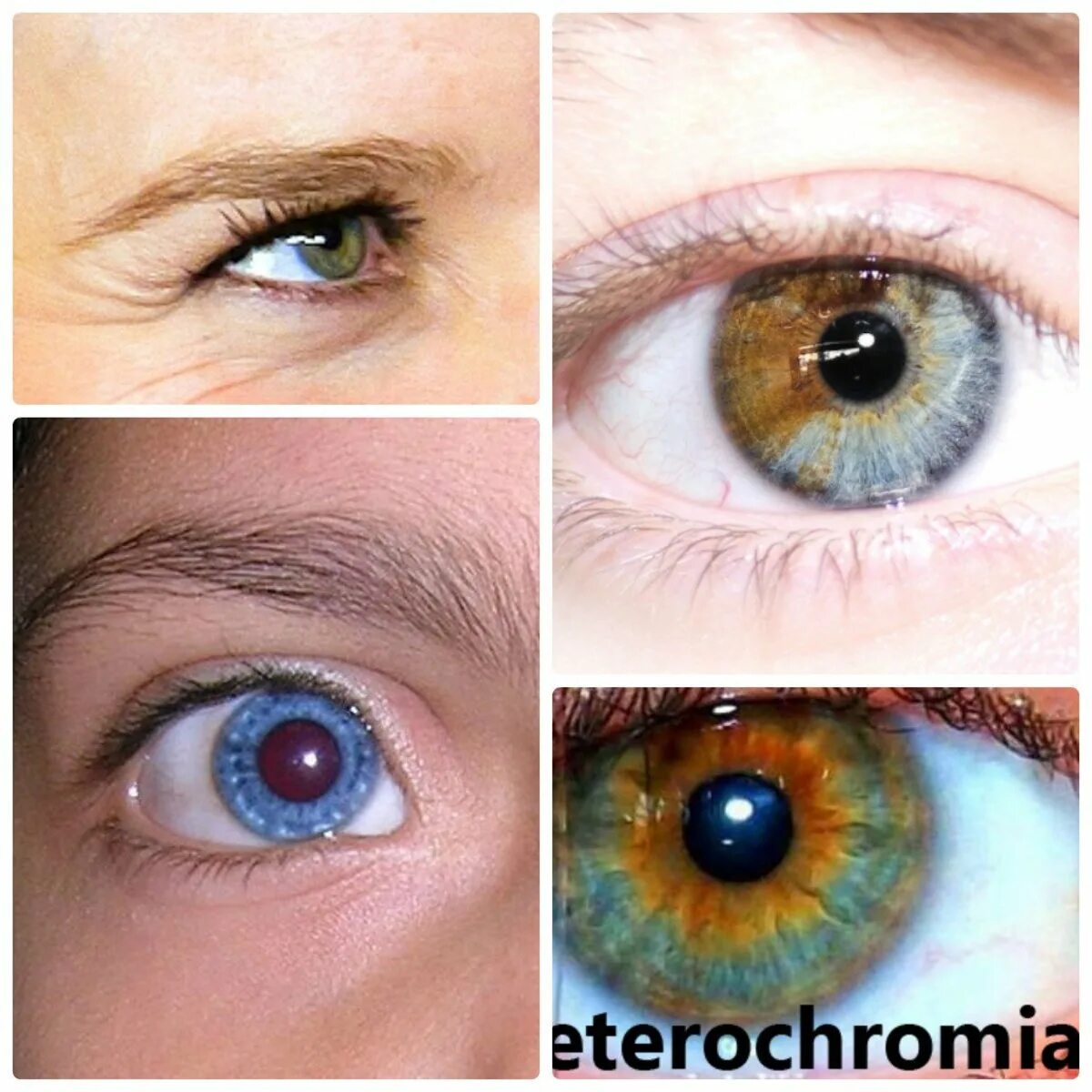 Цвет глаз человека определяется пигментацией. Центральная гетерохромия радужной оболочки. Цветные линзы гетерохромия. Гетерохромия Радужки глаз. Цвет глаз гетерохромия Центральная.