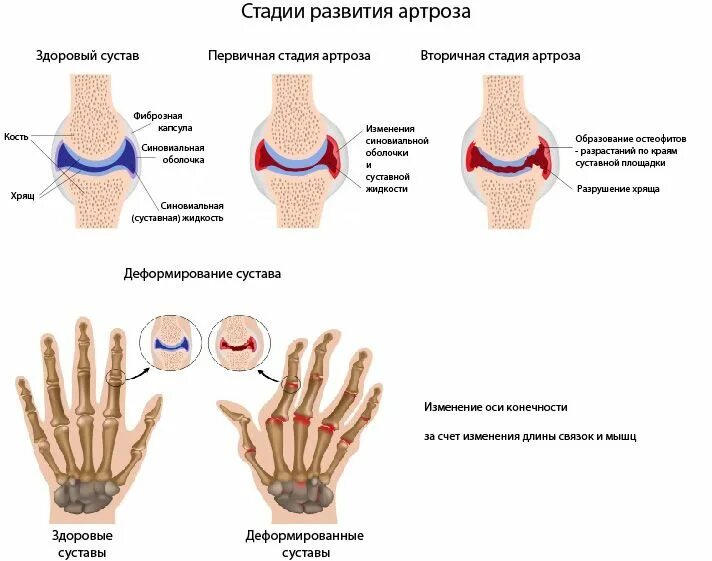 Схема развития деформирующего остеоартроза. Остеоартроз кистей деформирующий артроз. Артроз суставов кисти 3 степень. Остеоартроз пястно-фаланговых суставов. Изменения кисти рук