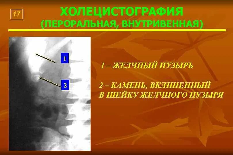 Желчекаменная болезнь рентген. Рентгенологические исследования (холецистография, холангиография):. Холецистография это исследование. Цель рентгенологического исследования желчевыводящих путей. Холецистография это исследование.
