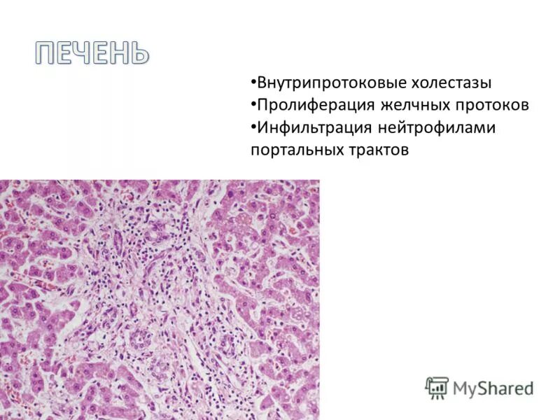 острый калькулезный холецистит. острый холецистит желчного пузыря. утолщение стенки желчного пузыря 5мм. острый бескаменный холецистит на узи. острый холецистит желчекаменная болезнь.