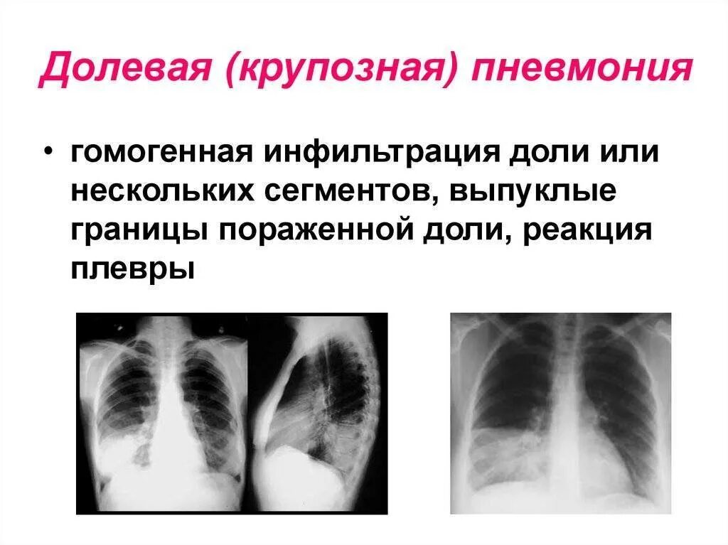 Пневмония в правой нижней доле. Правосторонняя очаговая пневмония рентген. Нижнедолевая очаговая пневмония рентген. Долевая пневмония рентген. Крупозная пневмония рентгенограмма.