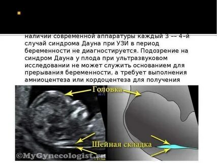Синдром дауна узи форум