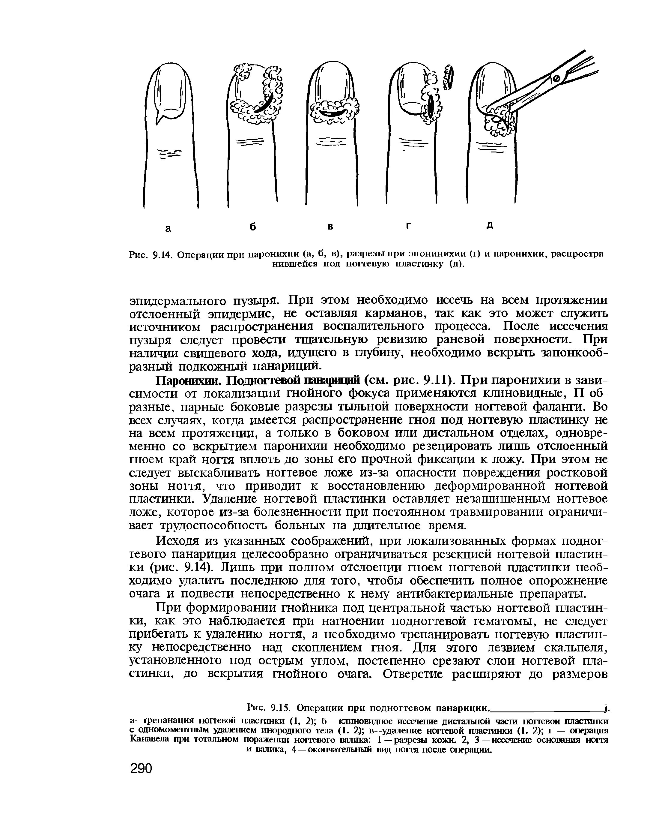 Подногтевой панариций разрезы. Подкожный панариций дренаж. Подногтевой панариций техника. Подногтевой панариций операция.