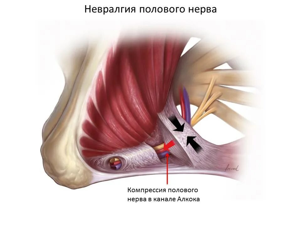 Блокады половые. Нейропатия бедренно-полового нерва. Срамной нерв анатомия у женщин. Половой нерв канал Алкока. Компрессия полового нерва половой нерв.