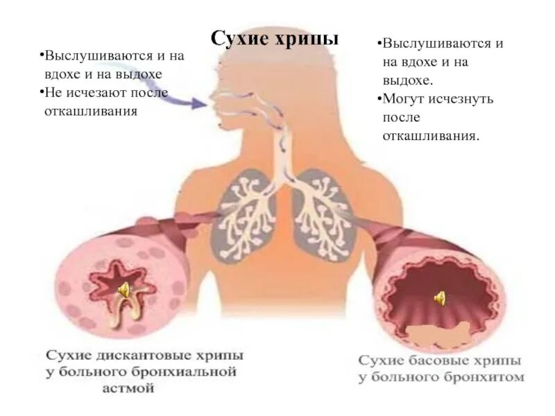 Звуки бронхита. Хрипы в легких при дыхании. Хрипы в легких при выдохе у взрослого. Сухие хрипы.