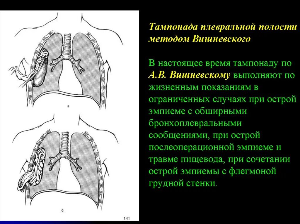 Лечение плевральной полости. Остаточная плевральная полость. Операции при эмпиеме плевры. Санация плевральной полости при эмпиеме плевры. Эмпиема плевры клиническая картина.