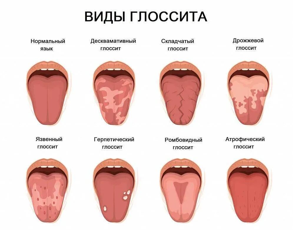 Признаки белого языка