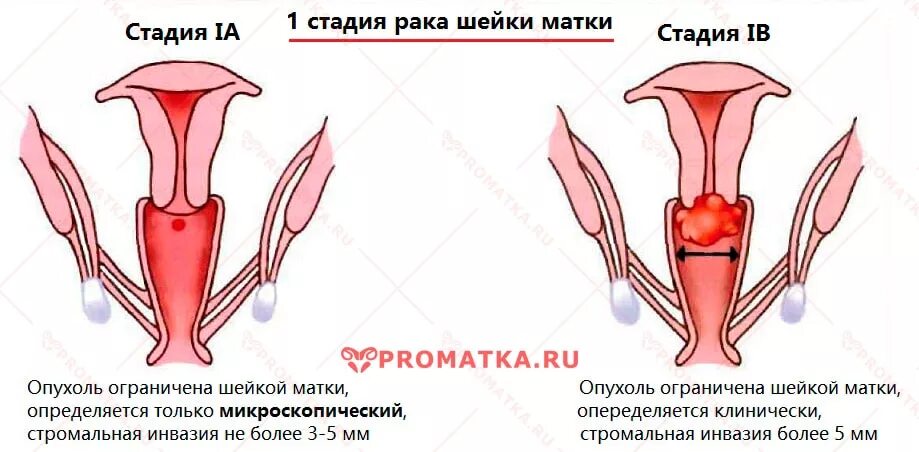 Рак матки первой стадии