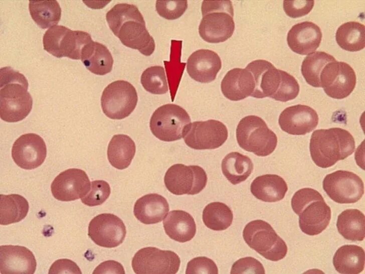 Тельце гейнца. Тельца Гейнца Эрлиха. Тельца Гейнца Эрлиха в эритроцитах. Включения эритроцитов тельца Гейнца Эрлиха.