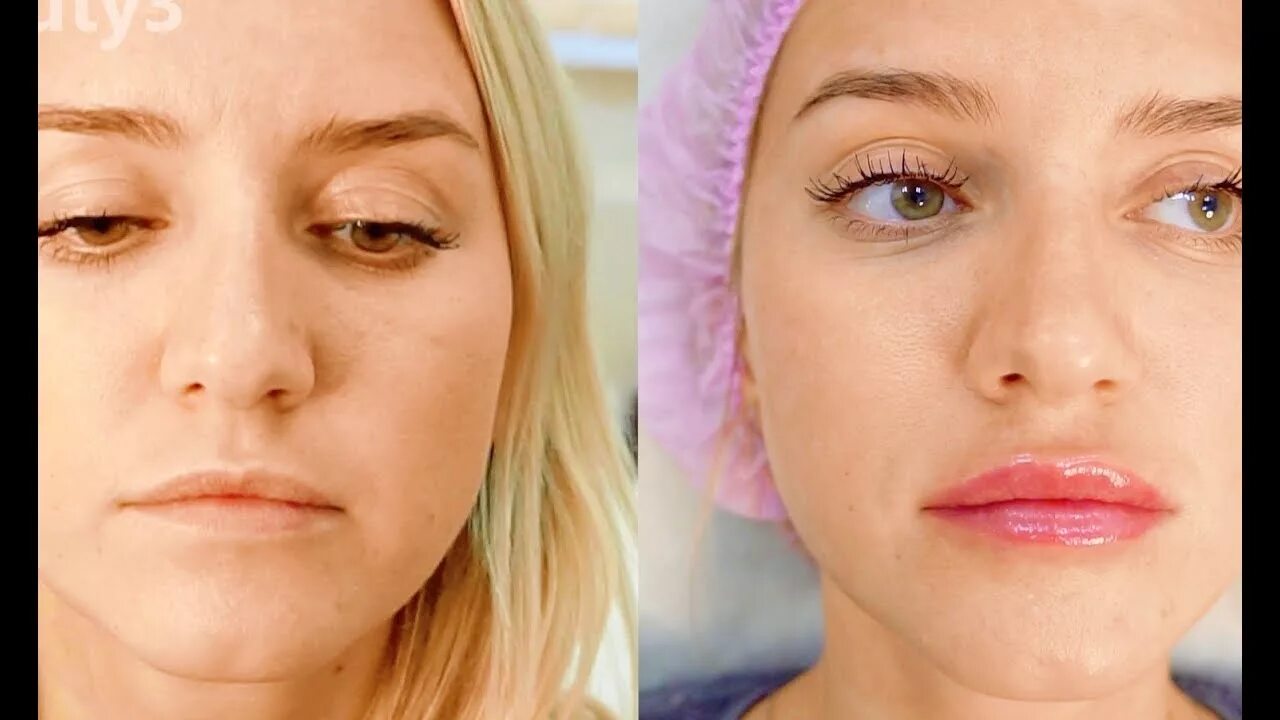 Lip enhancement, Lip injections, Lip fillers