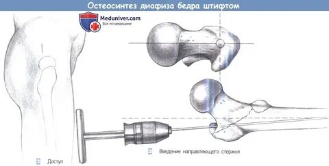 Операция остеосинтеза бедренной кости