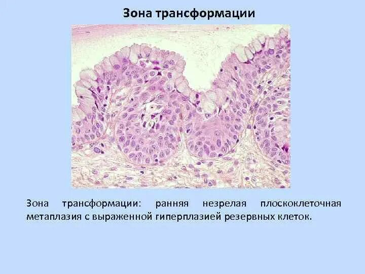 Зона трансформации шейки 2 типа. Зона трансформации метапластический эпителий. Зона трансформации шейки матки. Зона трансформации шейки 1.