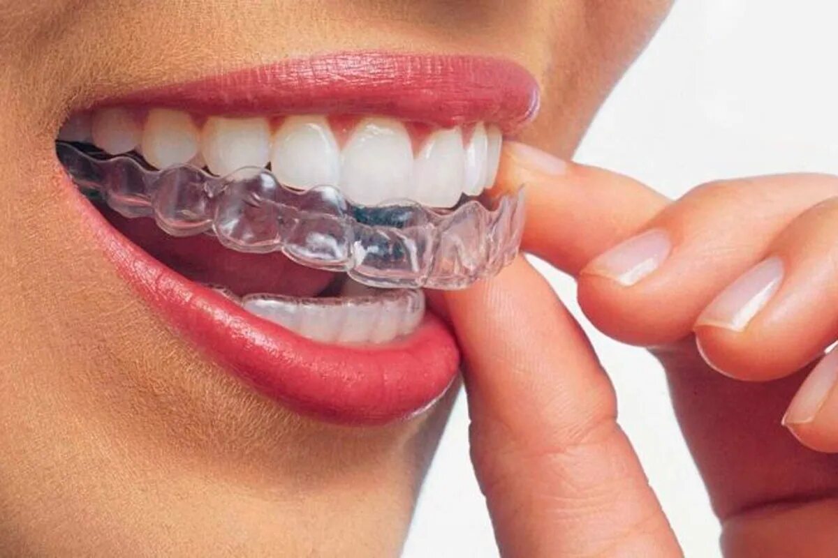 Ретенционная капа после брекетов. Невидимые брекеты элайнеры. Ортодонтическая капа элайнеры. Ретенционная капа ортодонт. Ортодонтические каппы (элайнеры).