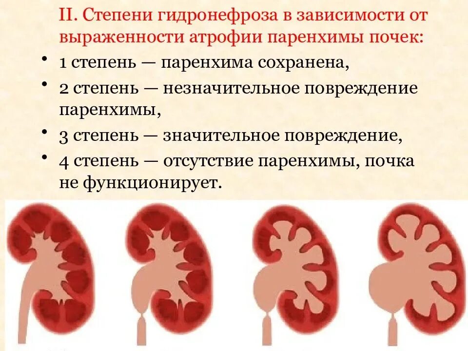 Пиелонефрит 2 степени гидронефроз. Гидронефроз 2 2 степени. Что значит расширены лоханки почек