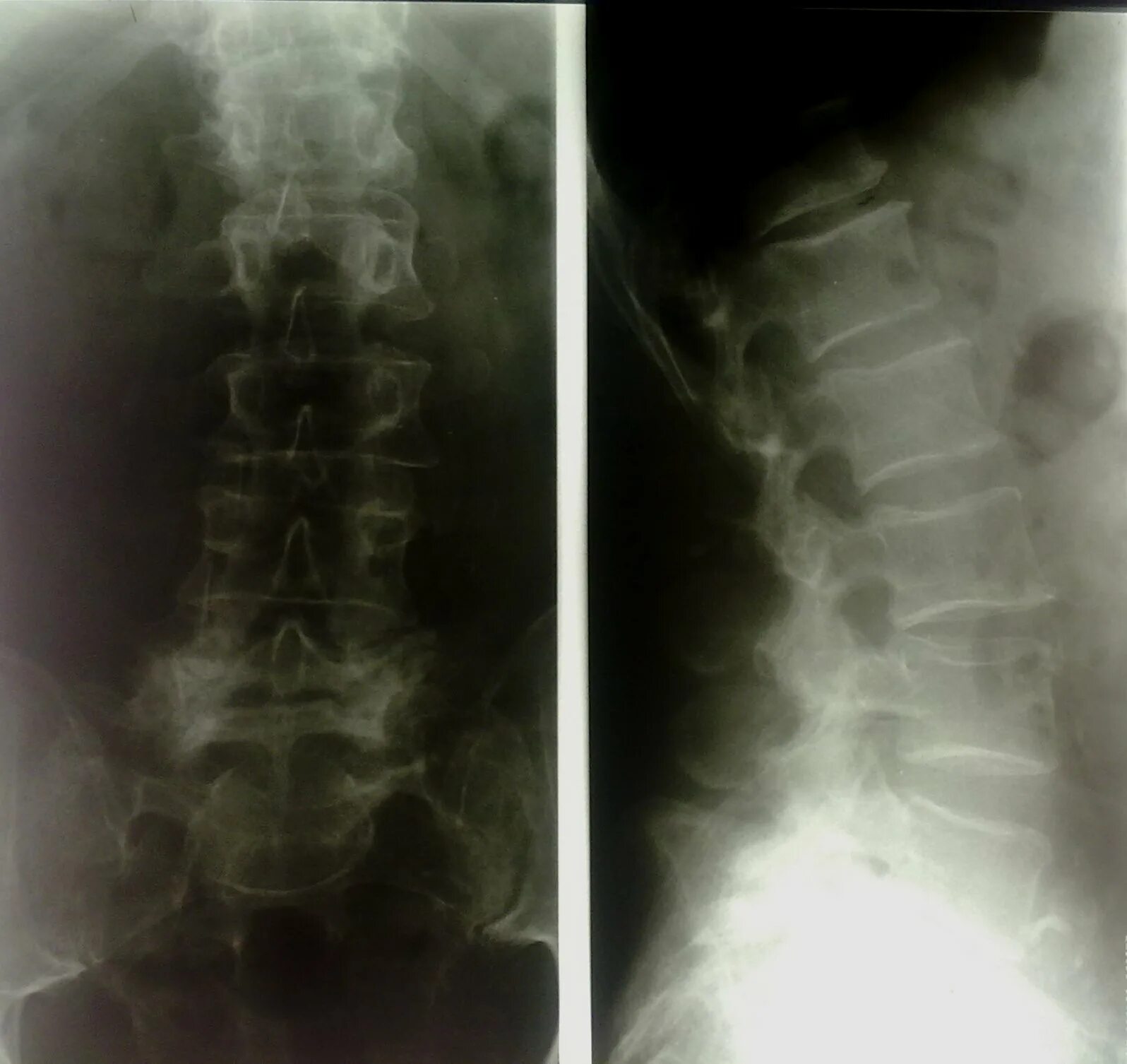 Рентгенография поясничного отдела позвоночника подготовка. Рентген пояснично-крестцового отдела. Рентген поясничного отдела позвонка. Поясничный отдел позвоночника рентген норма. Рентген нормального позвоночника грудного отдела.