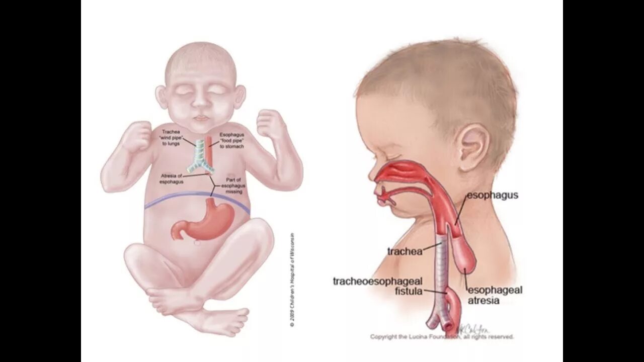 Пищевод новорожденного. Анатомия пищевода у детей. Пищеварительная система новорожденного.