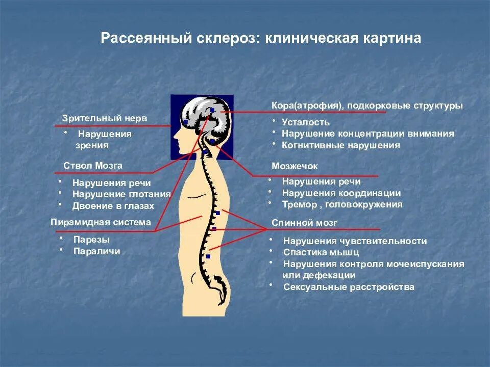 Рассеянный склероз. Симптомы рассеянного склероза. Клинические проявления рассеянного склероза. Симптомы рассеянного склероза у женщин. Симптомов появление головной