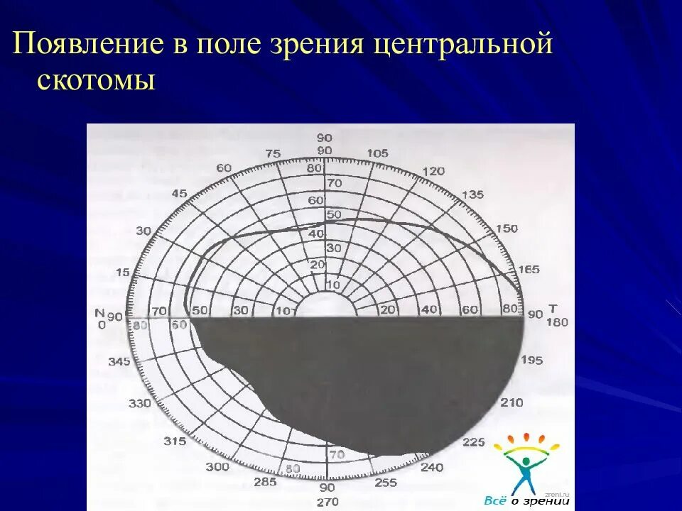 Центральные скотомы в поле зрения. Скотома Бьеррума. Относительная Центральная скотома. Абсолютная Центральная скотома. Центральное поле зрения