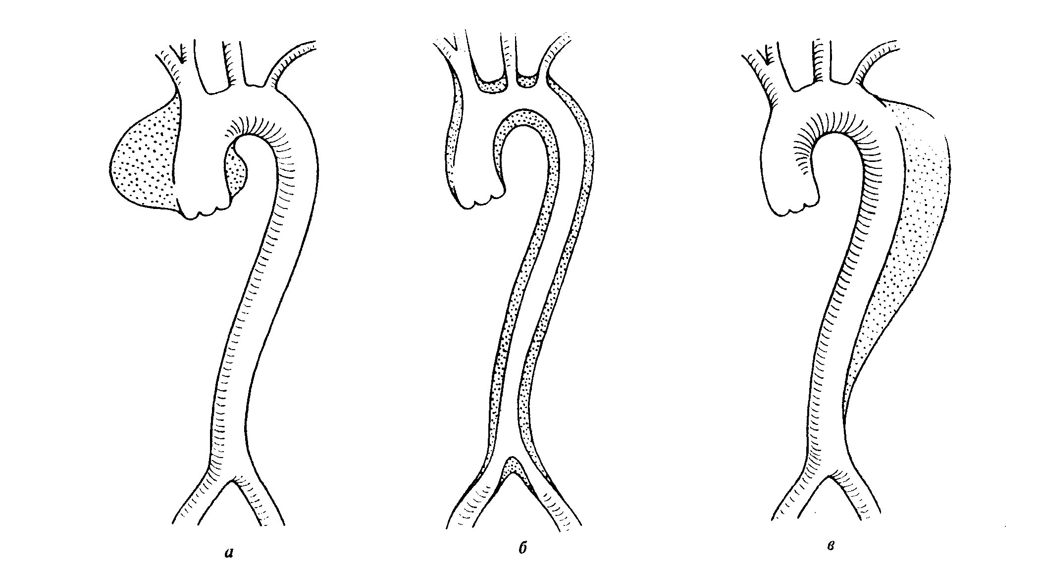 Расслаивающая аневризма дуги аорты. Расслаивающая аневризма аорты Тип 3а. Расслаивающая аневризма грудной аорты. Диссекция аорты и аневризма аорты. Аневризма восходящей аорты операция