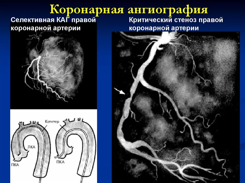Гемодинамически значимый стеноз артерий. Коронарография стеноз. ангиограмма сосудов сердца. правая коронарная артерия ангиограмма. селективная коронарная ангиография.