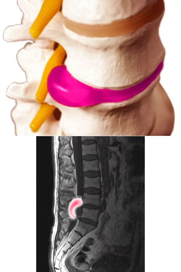 Межпозвонковая грыжа поясничного отдела лечение. Межпозвоночная грыжа пояснично-крестцового. Межпозвоночная грыжа крестцового отдела. Протрузия дисков позвоночника крестцового отдела. Протрузия крестцового отдела.