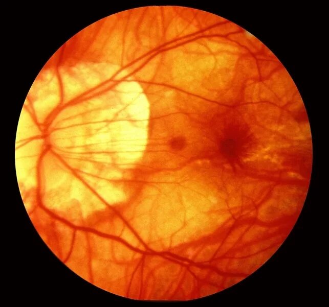 Миопический конус глазное дно. Стафилома зрительного нерва. Миопический конус