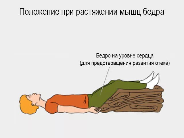Симптомы растяжения мышц. Положение при растяжении. растяжение бедренной мышцы.