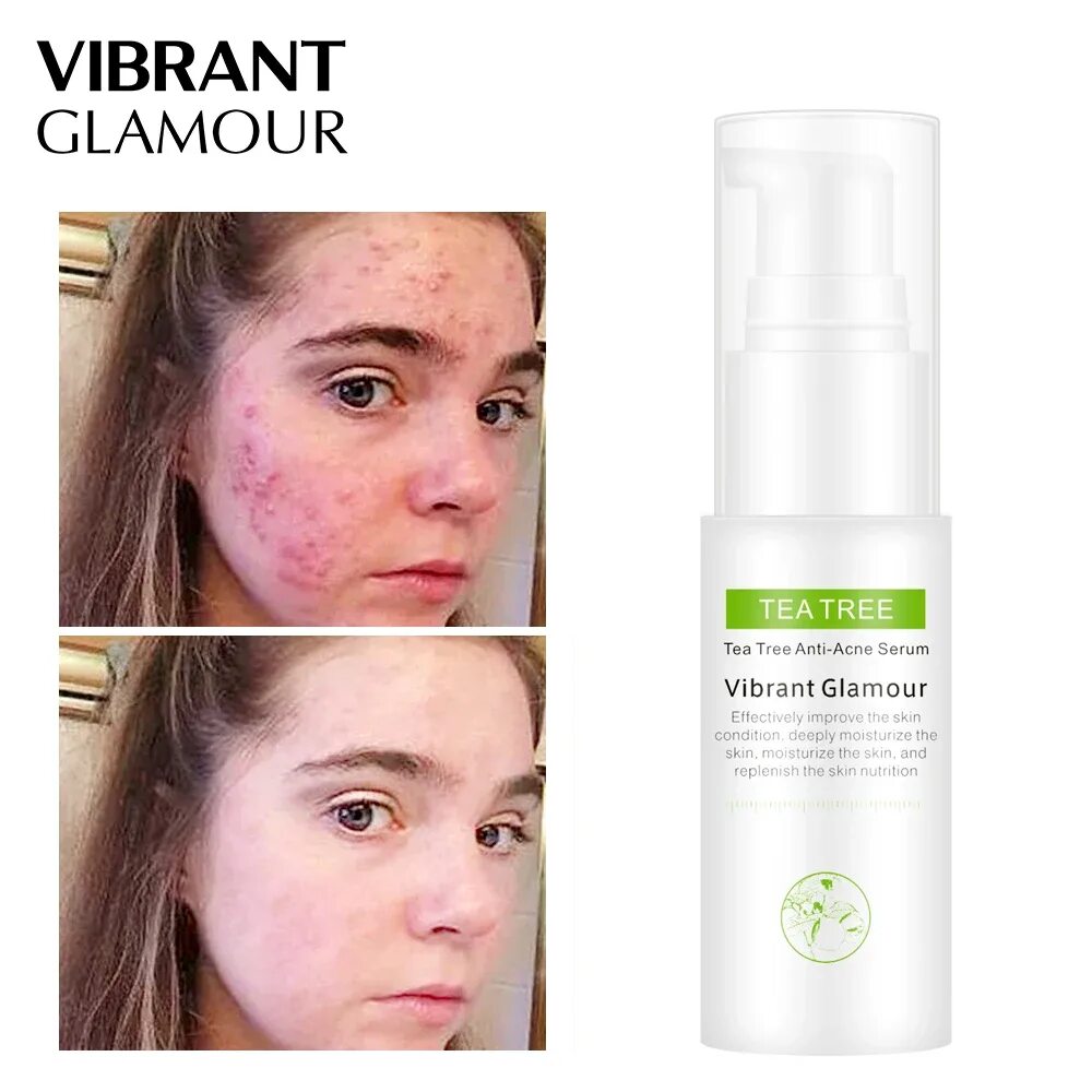 Сыворотка для лица face Serum Anti-acne Serum. Biomatrix Serum Anti acne 30ml. Сыворотка для лица от акне и прыщей. Glow clean 3в1 Anti acne Serum. Крем убирающий прыщи