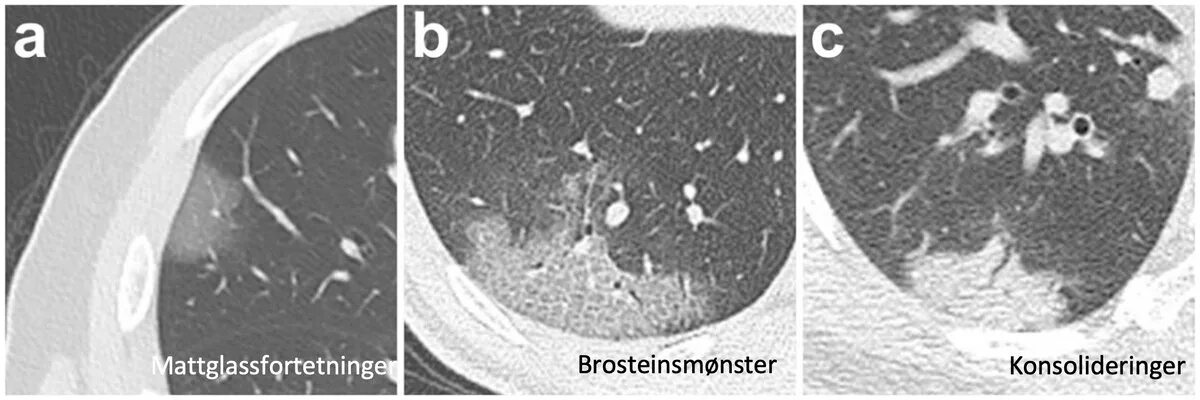 Интерстициальная пневмония на кт. Матовое стекло на кт при пневмонии. Консолидация матового стекла кт. Матовое стекло на кт при коронавирусе. Кт легких ковид