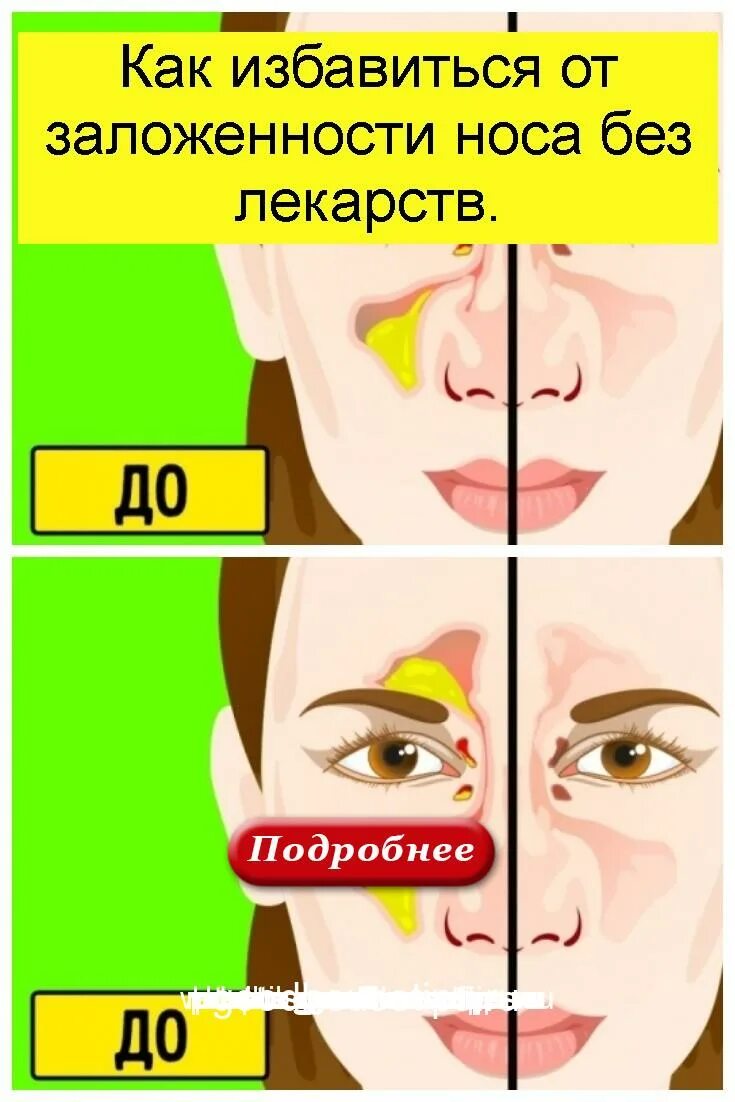 Как снять заложенность носа без
