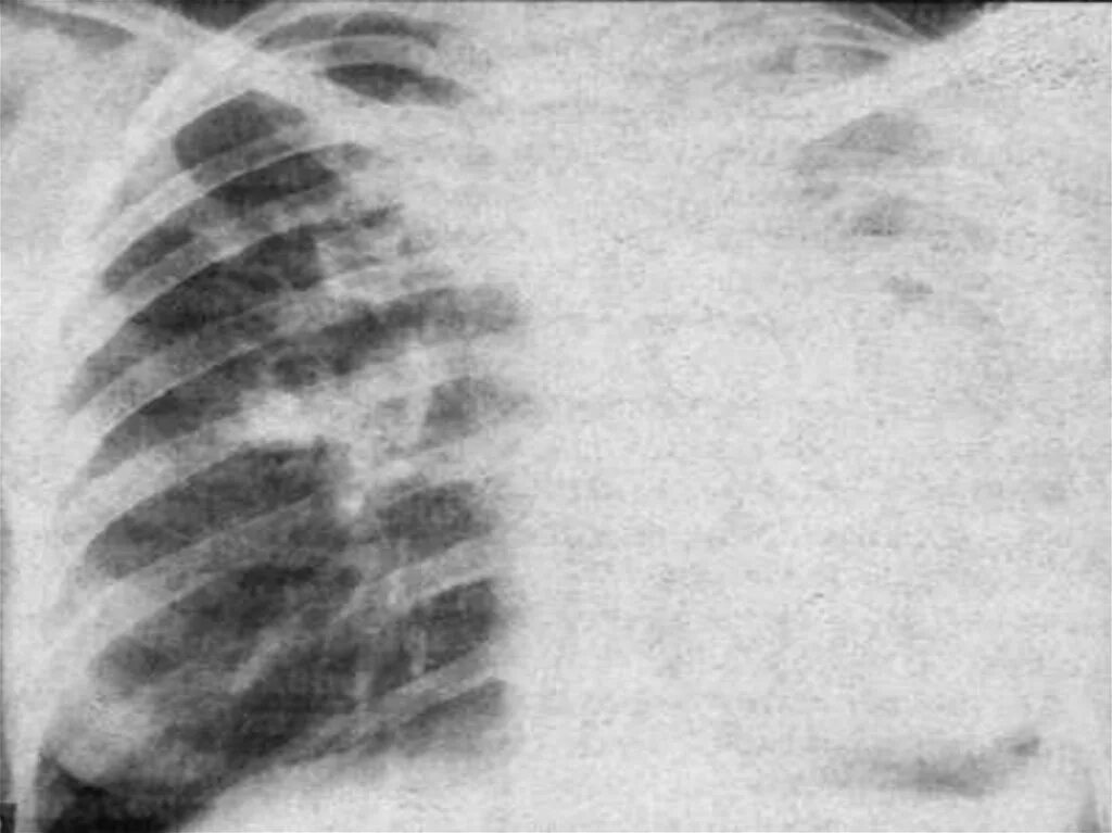 Затемнение в левом легком. Крупозная пневмония рентгенограмма грудной клетки. Казеозная пневмония рентгенограмма. Тотальная пневмония легкого рентгенограмма. Казеозная пневмония рентген синдром.